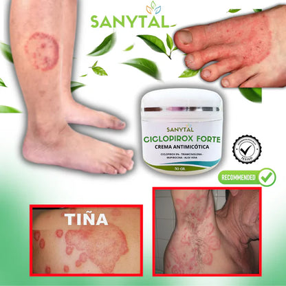 CICLOPIROX FORTE 8% - ELIMINA LA TIÑA INGUINAL