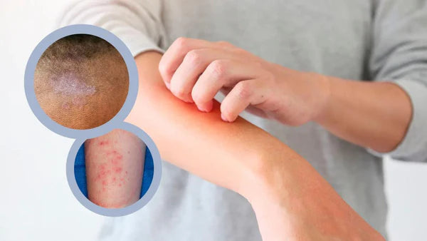 CICLOPIROX FORTE 8% - ELIMINA LA TIÑA INGUINAL